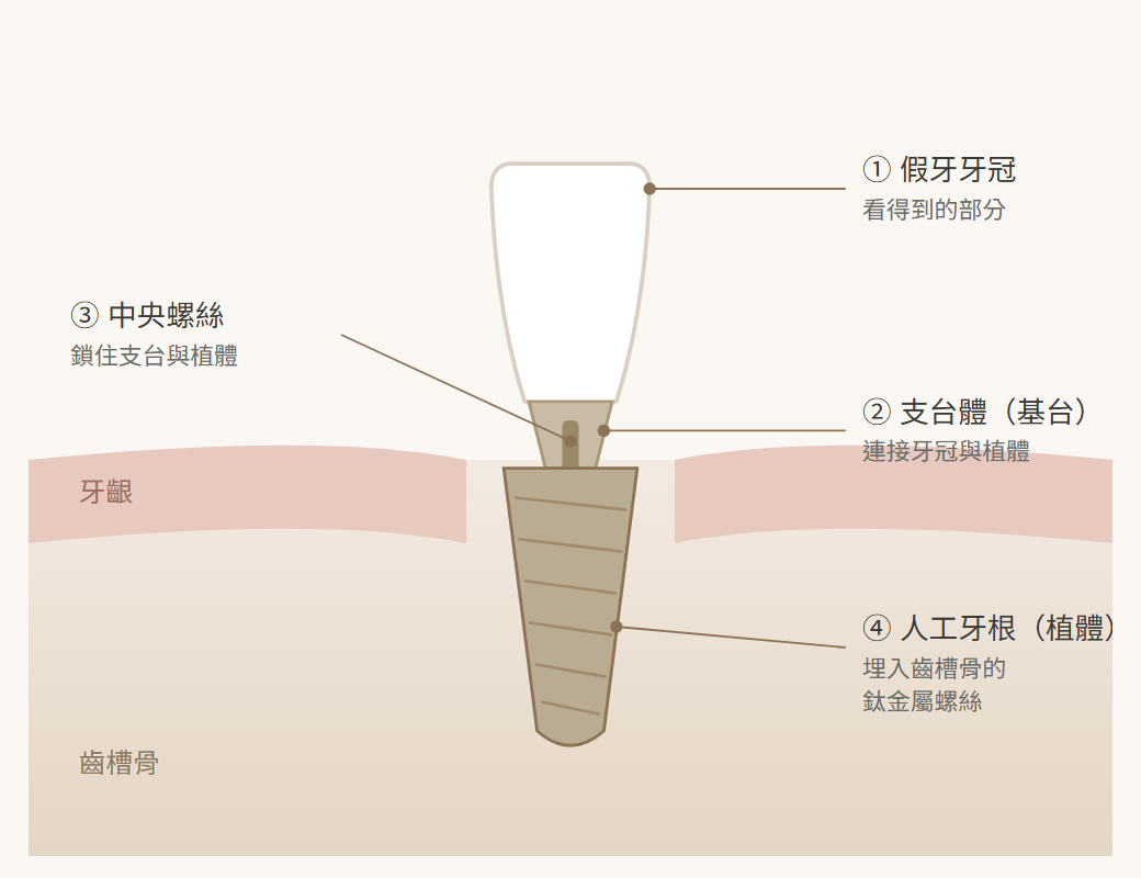 植牙結構示意圖:假牙牙冠、支台體、中央螺絲與人工牙根植體