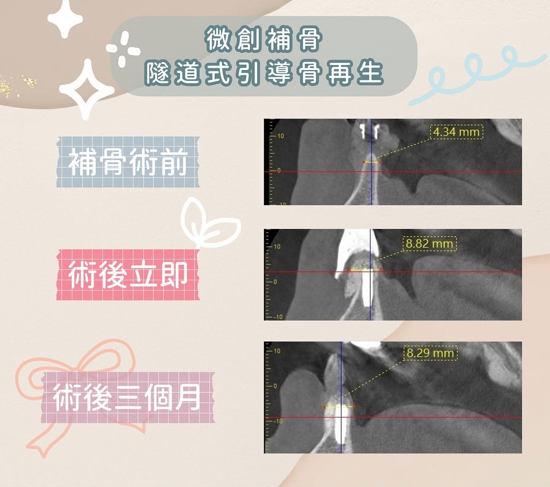 隧道式引導骨再生補骨術前齒槽骨寬度約 4.34mm，術後立即約 8.82mm，術後三個月約 8.29mm，顯示補骨後骨寬度增加並大致穩定維持。